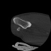 SPORK, NICO - 22.03.1976 - 02.08.2022 - CT obere Extremität - 17:51:17